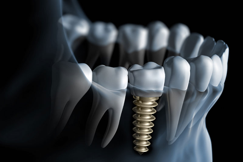 dental implant 3d graphic